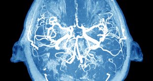 Glial Cell Transplants Alleviate Huntington’s Symptoms and Prolong Life